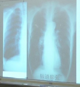 左側：正常な肺　右側：COPDの肺